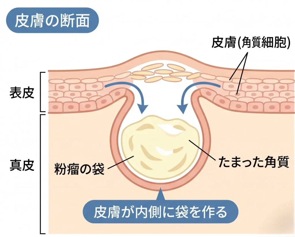 皮膚科専門医監修。粉瘤が形成されるメカニズム(原因と仕組み)を視覚的に解説