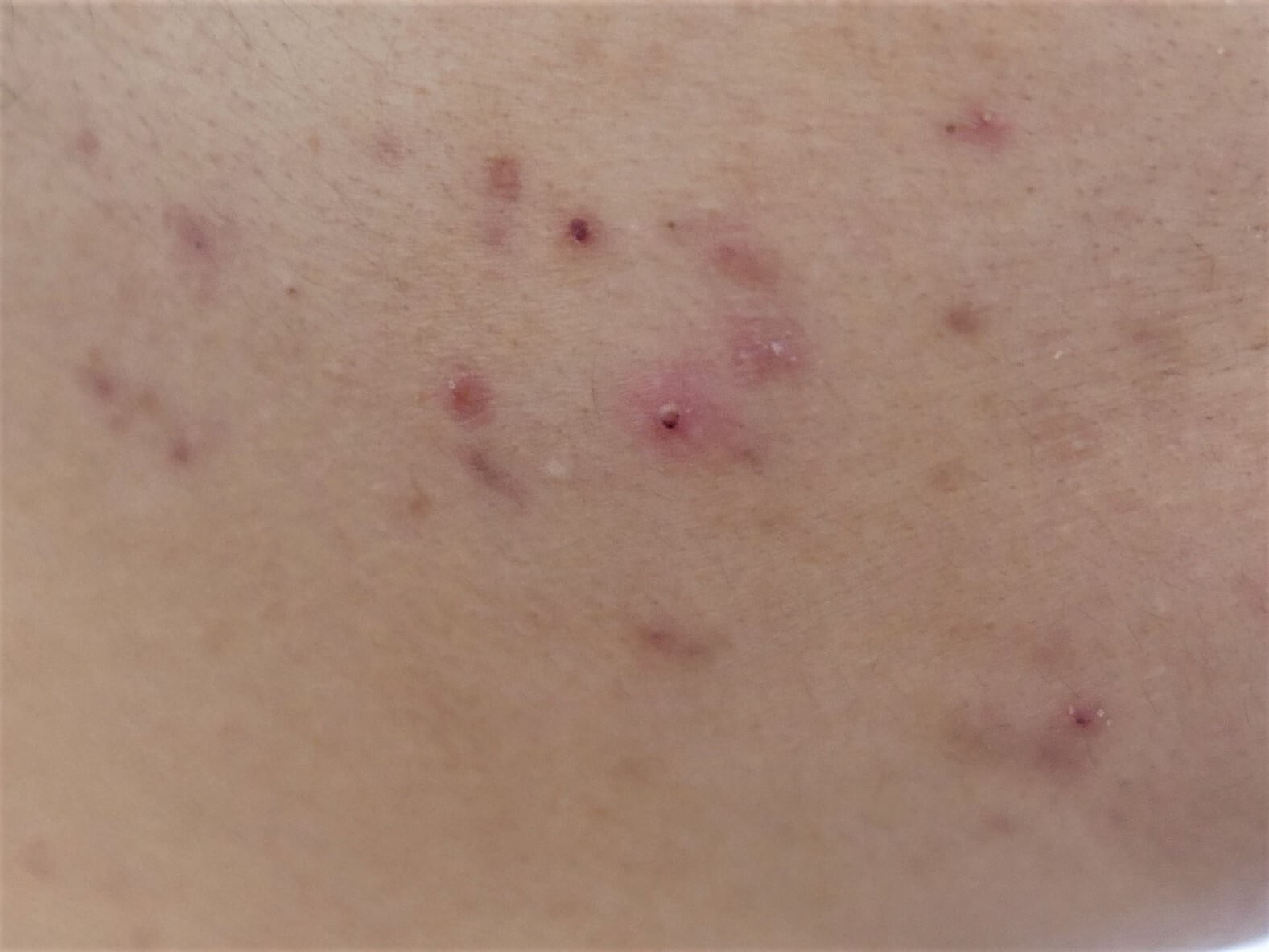 どのような皮膚の悩みがVビームの治療対象となるのか？