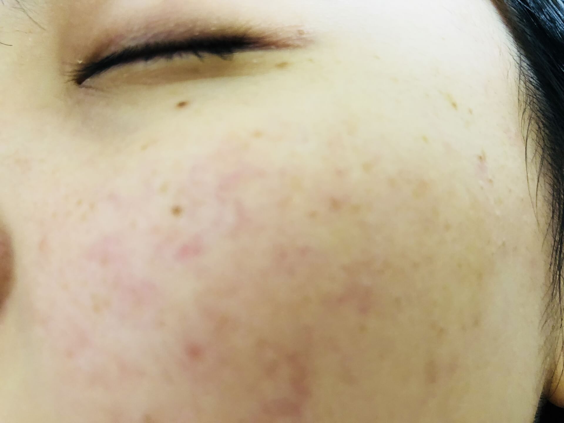 ニキビ跡が毛穴に与える影響とは？