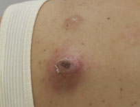 粉瘤治療の目的と治療法の種類について