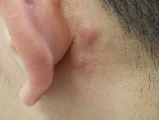 粉瘤ができやすい場所や症状の流れをわかりやすく解説