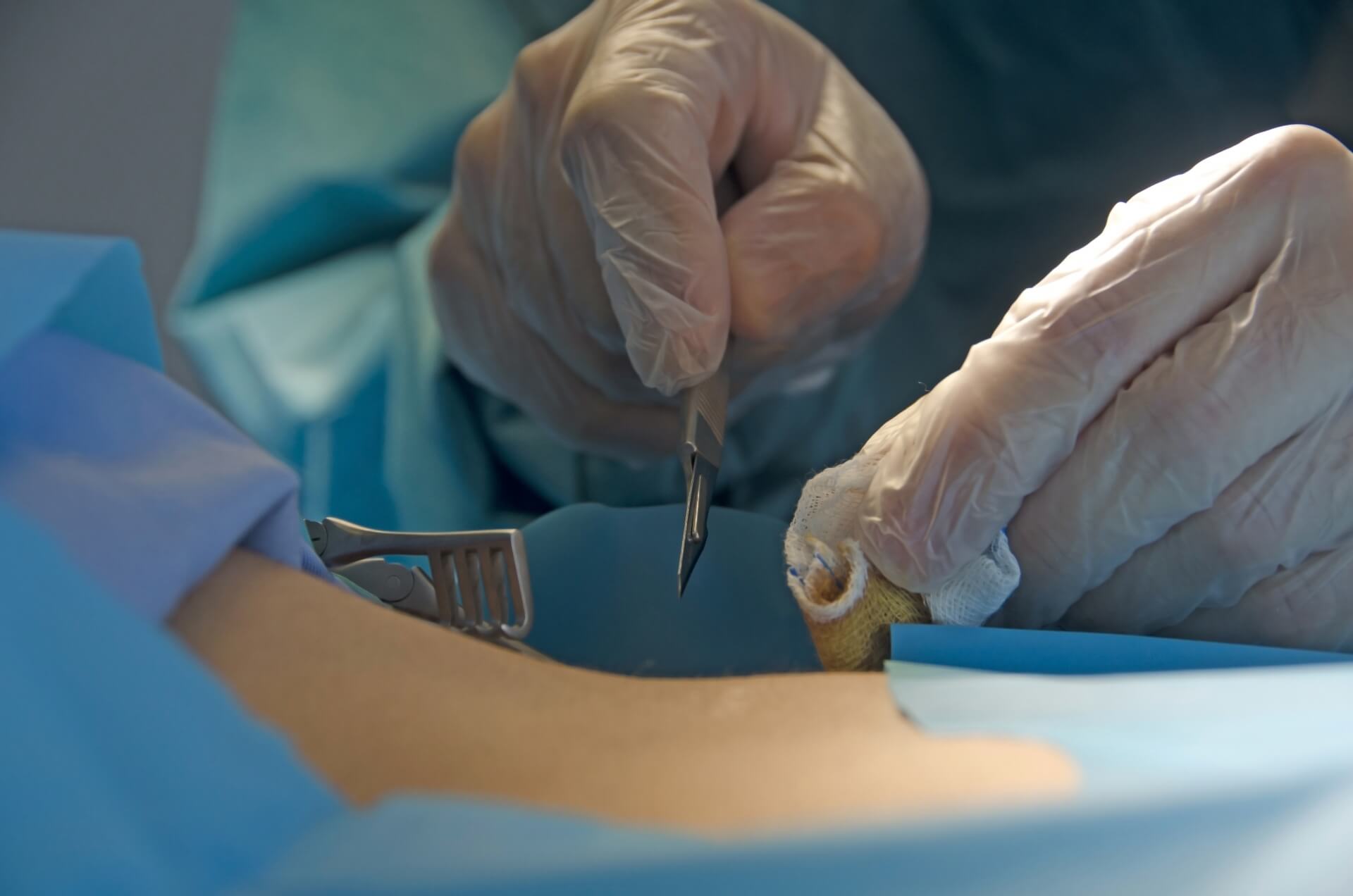 粉瘤の手術方法にはどのような種類がある？