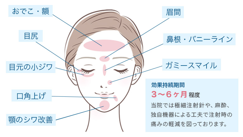 表情ジワ治療